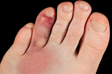 fractured toes vs broken toes