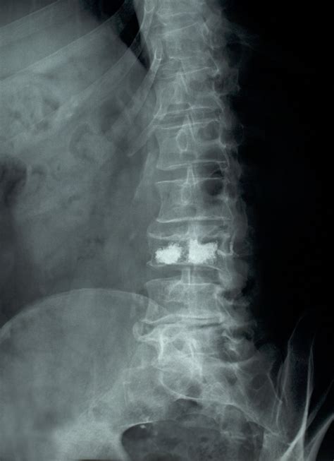 fractured vertebrae