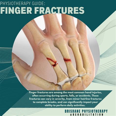 fractures of the finger