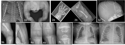 fragile bones in children
