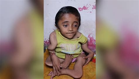 fragile bones in kids