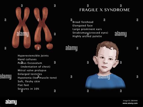 Fragile X Hands