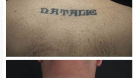 Free Tattoo Removal Houston Dermatologist Explains How Works