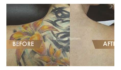 Free Tattoo Removal In Philippines √ Update Price 2023