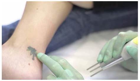 Free Tattoo Removal Portland Designs For Commercial Use Rights What Is Laser