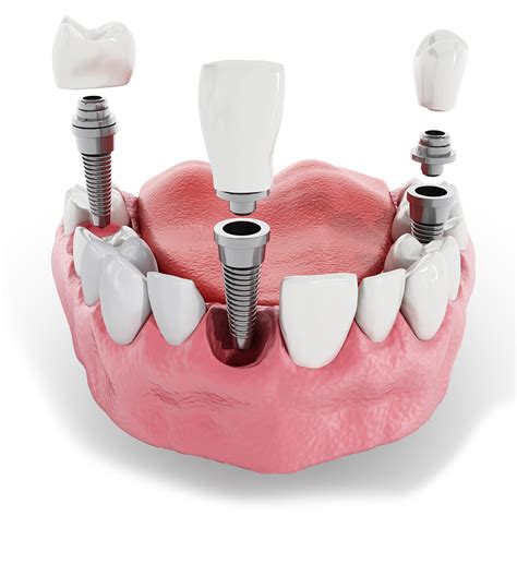 free dental implants in ny