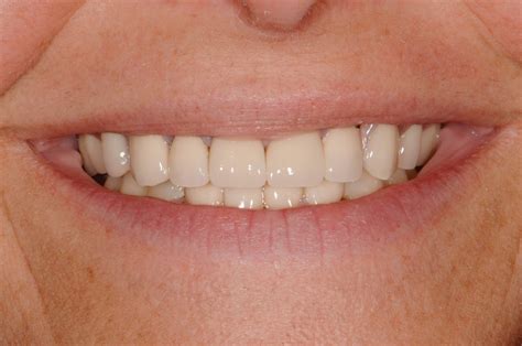 free dentures in kalamazoo