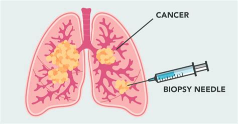 free mesothelioma test for lung cancer