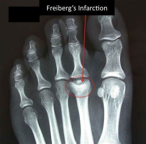 freiberg disease icd 10
