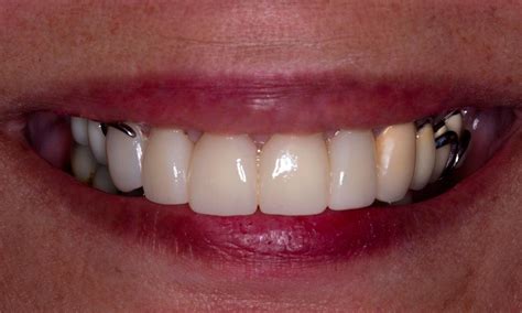 Front Teeth Partial Dentures Pictures