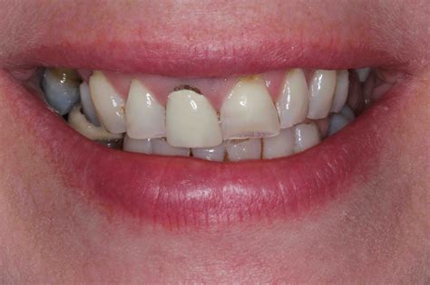 front tooth replacement uk