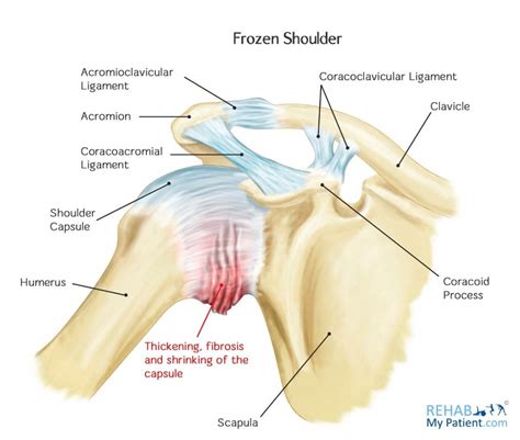 Frozen Shoulder Blade