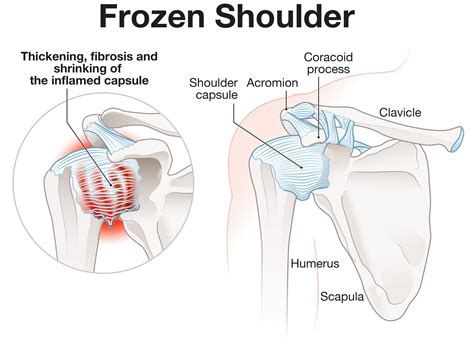 Frozen Shoulder Left