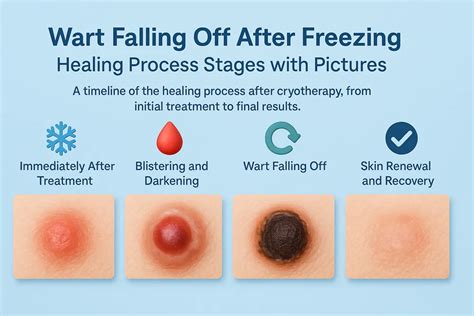 frozen wart stages