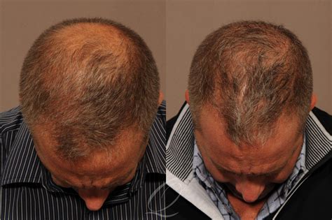 FUE Hair Transplant 3,055 Grafts, One Surgery, Before & After Results!