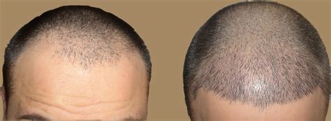 fue hair transplant in dubai