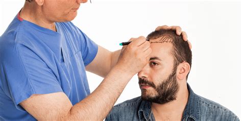 fue hair transplant new jersey cost