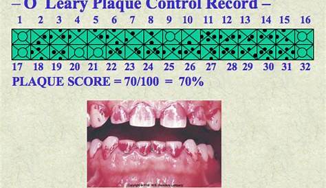 Full Mouth Plaque Score Oleary The Presence Of Remodeled And Mixed Atherosclerotic