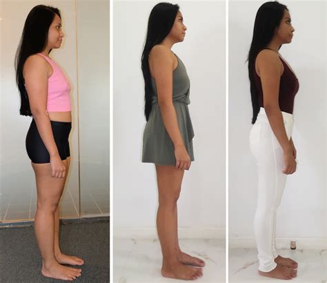 full body liposuction before and after