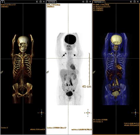 full body pet scan images