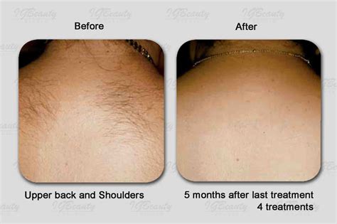 full brazilian laser hair removal pain