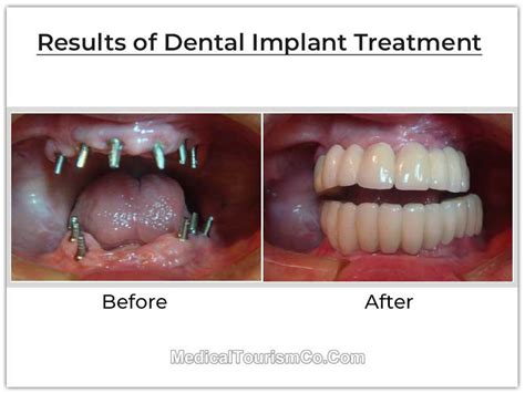 full dental implants cost in mexico