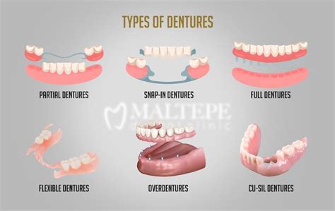 Full Denture Types