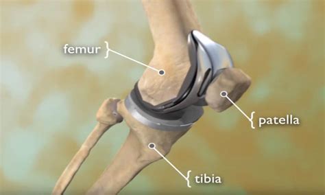 What to Expect from Full Knee Replacement Surgery: A Comprehensive Guide to Recovery and Results