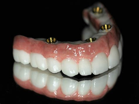 full mouth dental implants utah