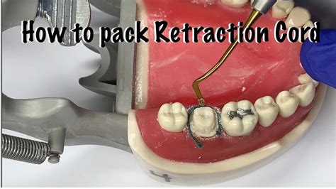 Function Of Retraction Cord