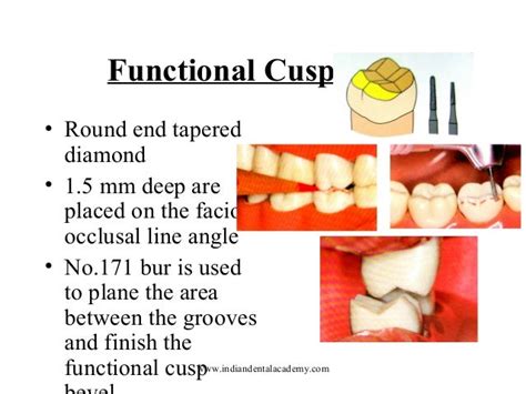 Functional Cusp Of Maxillary Teeth