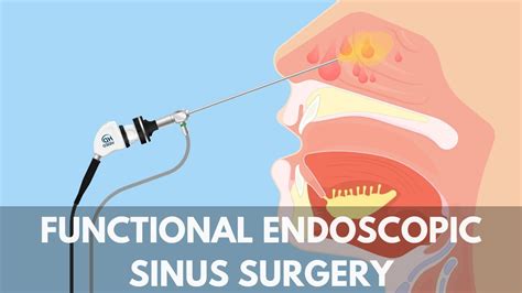 Unlocking Sinus Relief: What You Need to Know About Functional Endoscopic Sinus Surgery