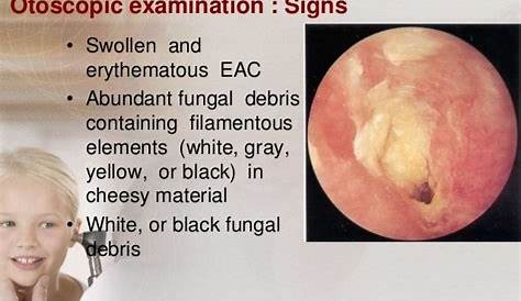 Otitis Externa Outer Ear Infection Or Swimmers Ear Dr Sean Flanagan