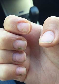 Fungus On Nails From Acrylic Nails