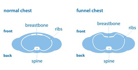 Funnel Chest Asthma