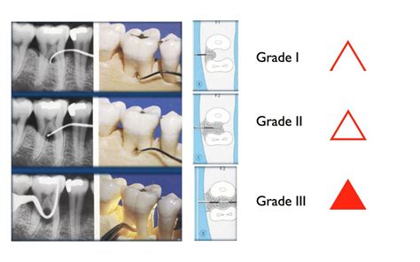 furcation classification dental