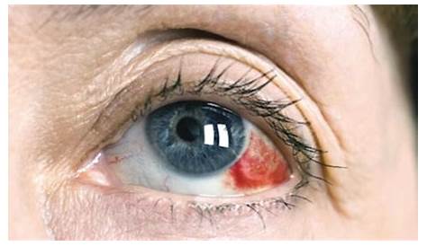 Göz Ameliyatı Sonrası Gözde Kanlanma