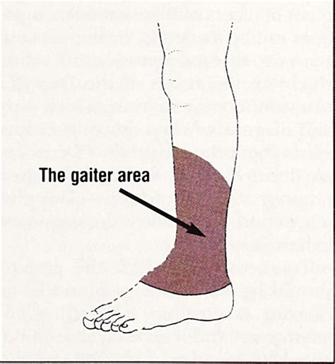 Gaiter Area Ulcer