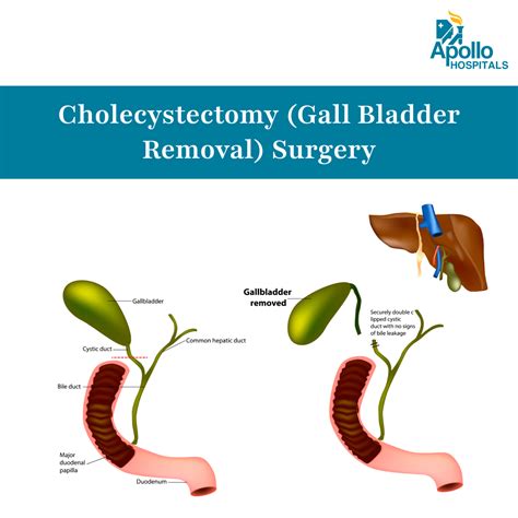 What to Expect from a Gall Bladder Removal Operation: Risks, Benefits, and Recovery Tips