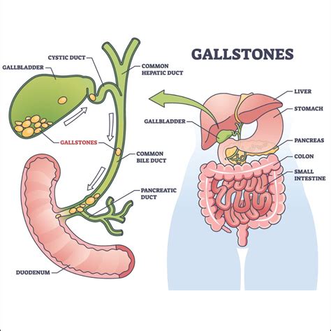 Understanding Gall Bladder Stones: Causes, Symptoms, and Effective Treatment Options