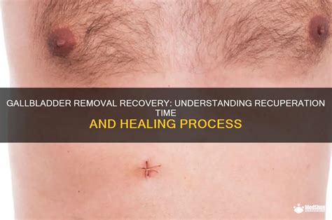 Gallbladder Removal Healing Process: A Comprehensive Recovery Guide