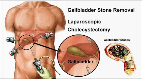 Effective Gallbladder Stone Removal: What You Need to Know