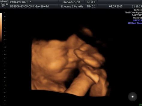 Gambar Scan Bayi Lelaki / Bayi lelaki berusia 14 bulan yang mengalami