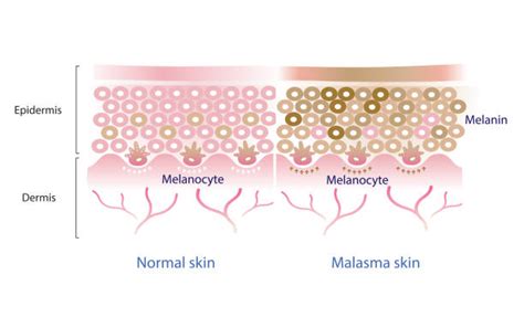 Gambar melasma