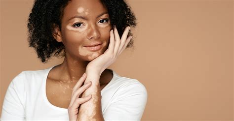 Gambar vitiligo