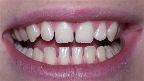 Gap Between Bottom Teeth