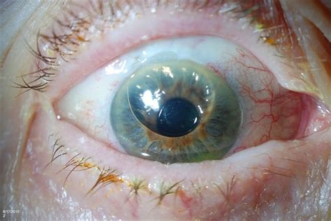 gas bubble in eye for retinal surgery