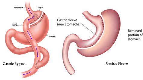 Gastric Sleeve and Gastric Bypass Surgery