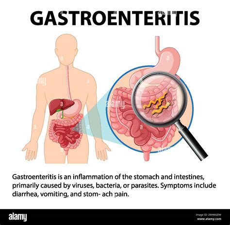 gastroenteritis