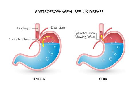 gastroesophageal reflux disease definition